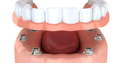 affordable dentures leesburg