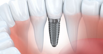 Dental Implants